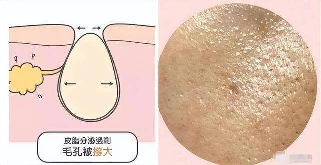 毛孔粗大做什么医美项目比较好（毛孔粗大怎么办？）