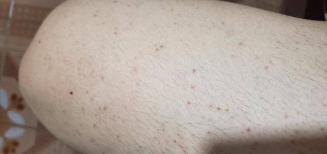 得阴虱后家中怎么清理（阴虱是如何传播的？）