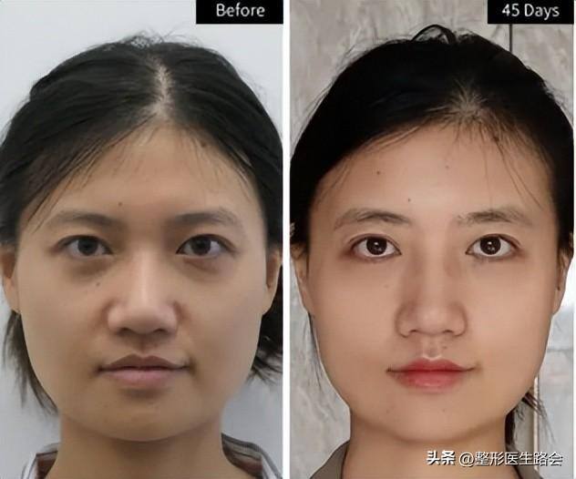 面部提升做什么项目（这3个整形项目，提升面部颜值最快而且效果改善最好，但未必适合所有人）