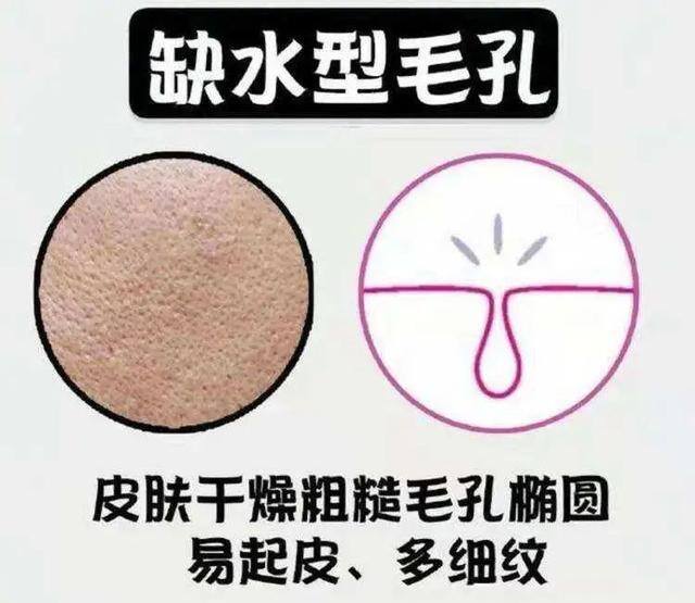 毛孔粗大做什么医美项目比较好（毛孔粗大怎么办？）