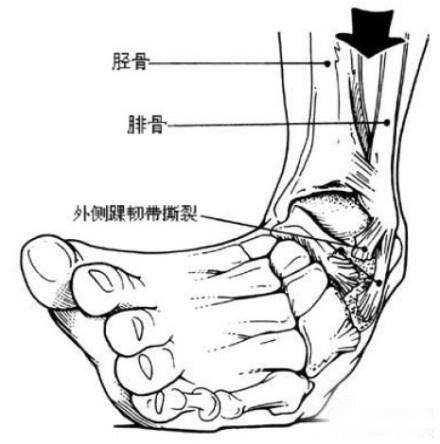 脚崴了可是必须要上班怎么办（关于崴脚的小知识）