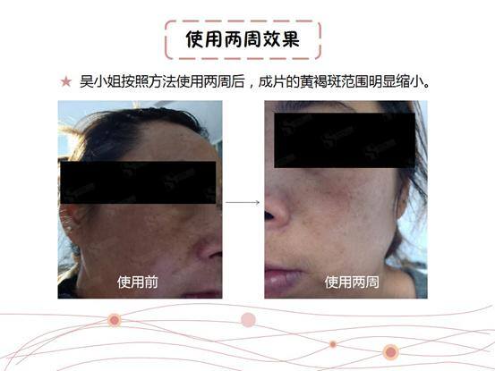自己在家祛斑最快的方法（科学有效的淡斑方法，在家就能做）