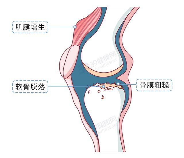 宫腔积液做什么运动最好排出（如何保护膝关节）