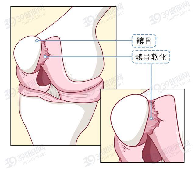 宫腔积液做什么运动最好排出（如何保护膝关节）