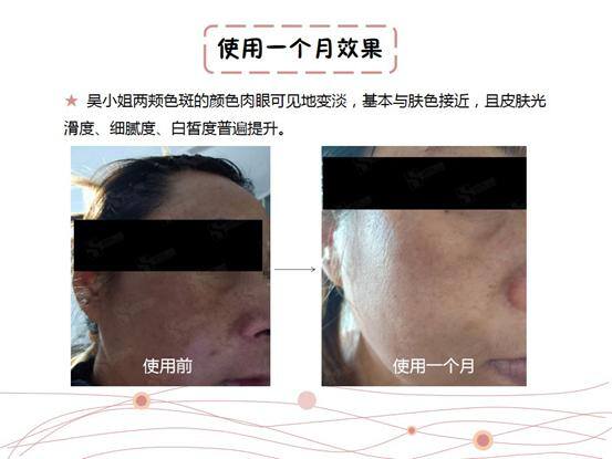 自己在家祛斑最快的方法（科学有效的淡斑方法，在家就能做）