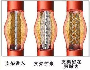 现在做一个心脏支架需要多少钱